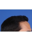 After Hair Transplant&nbsp;Front